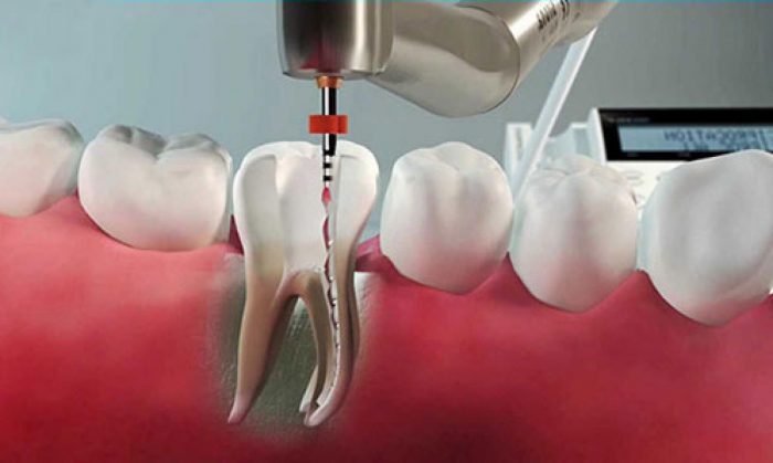 root canal specialist saibaba colony