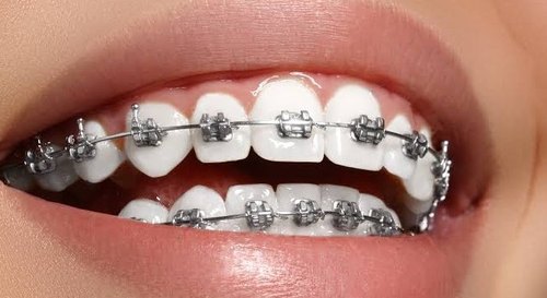 dental braces cost in coimbatore