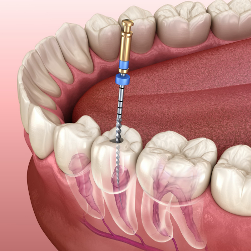 root canal treatment cost in coimbatore