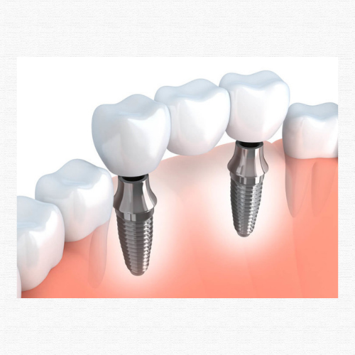 painless dental implants Coimbatore