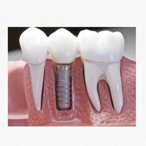 dental implants saibaba colony