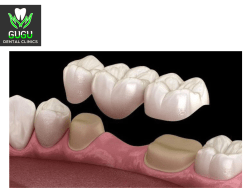 Dental bridges treatment