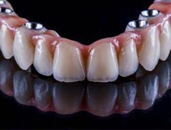 Full arch dental implants