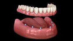 Overdenture treatment