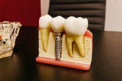 Single tooth implant