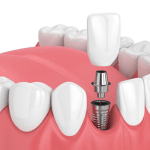 Single tooth dental implants
