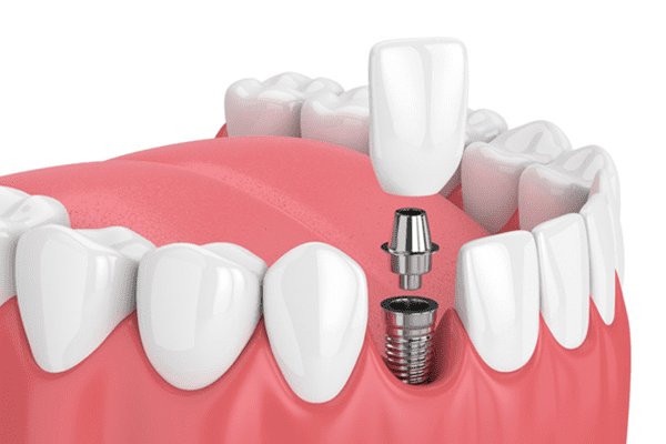 Single tooth dental implants Single tooth dental implants