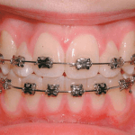 Orthodontics treatment
