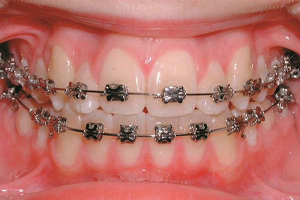 Orthodontics treatment Orthodontics treatment