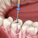 Root canal treatment