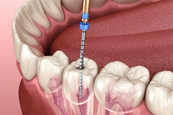 Root canal treatment Root canal treatment