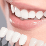 Wisdom teeth whitening