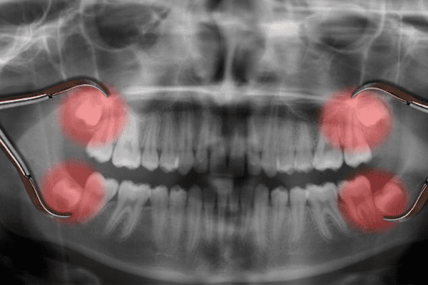Wisdom tooth removal Wisdom tooth removal