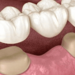 Dental crowns and bridges