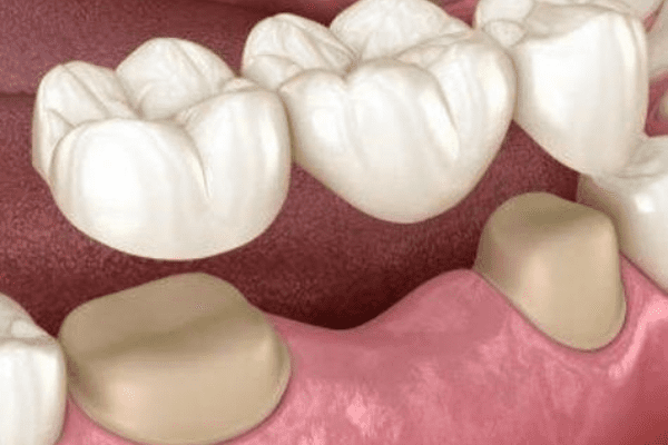 Dental crowns and bridges Dental crowns and bridges