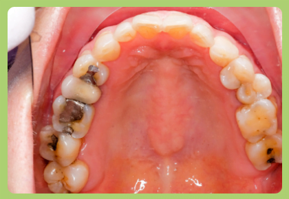 Dental Filling in Coimbatore