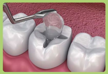 Dental Filling in Coimbatore