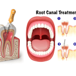 Root Canal Treatment in Coimbatore