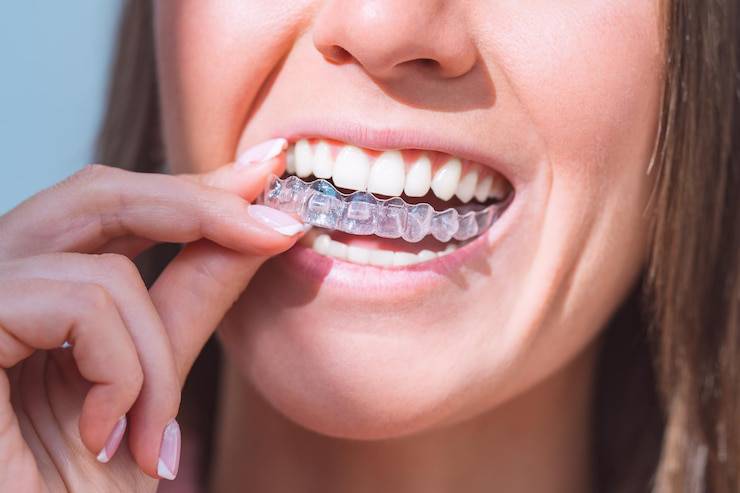 Invisalign Treatment in Coimbatore Invisalign Treatment in Coimbatore